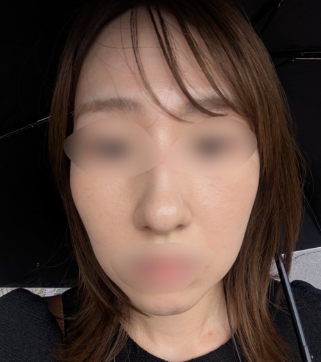 after photo: IPL(光/フォト治療), ピーリング