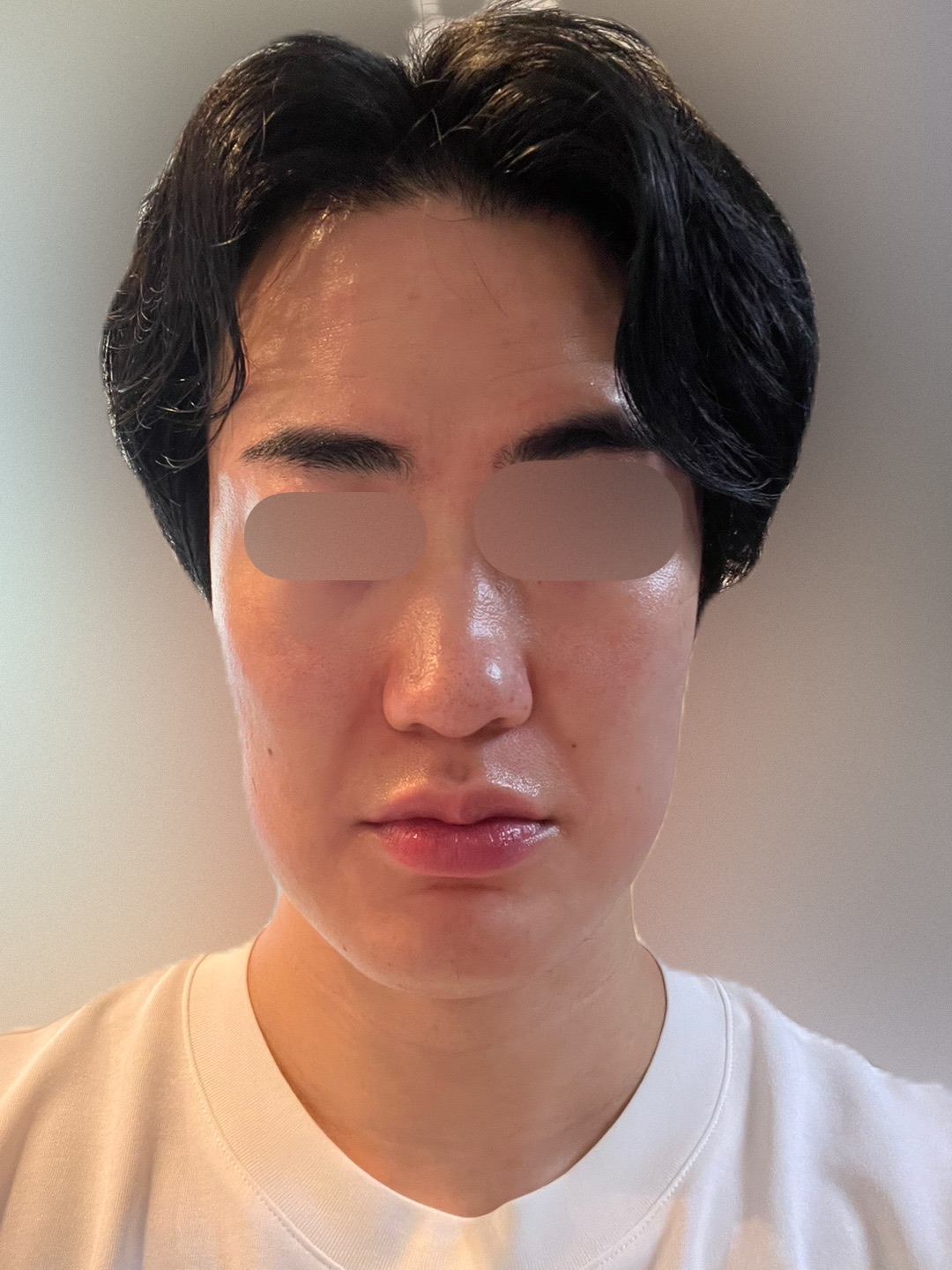 エレクトロポレーション全顔 【選べる薬剤1種付き】 | Karis Beauty Clinic