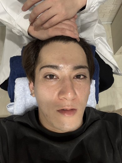 before photo: ダーマペン