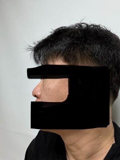 before photo: 눈밑지방재배치