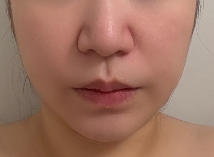 after photo: リニアファーム(ハイフ)