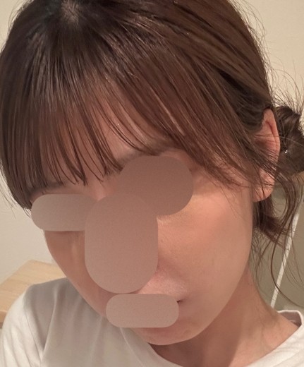 before photo: 美容注射・点滴