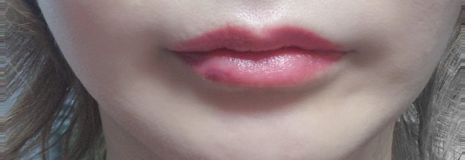 after photo: 이마필러