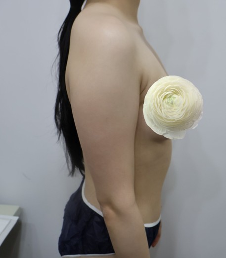 before photo: 팔지방흡입