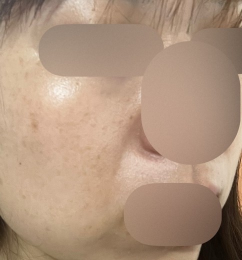 after photo: レーザートーニング, 診断・検査