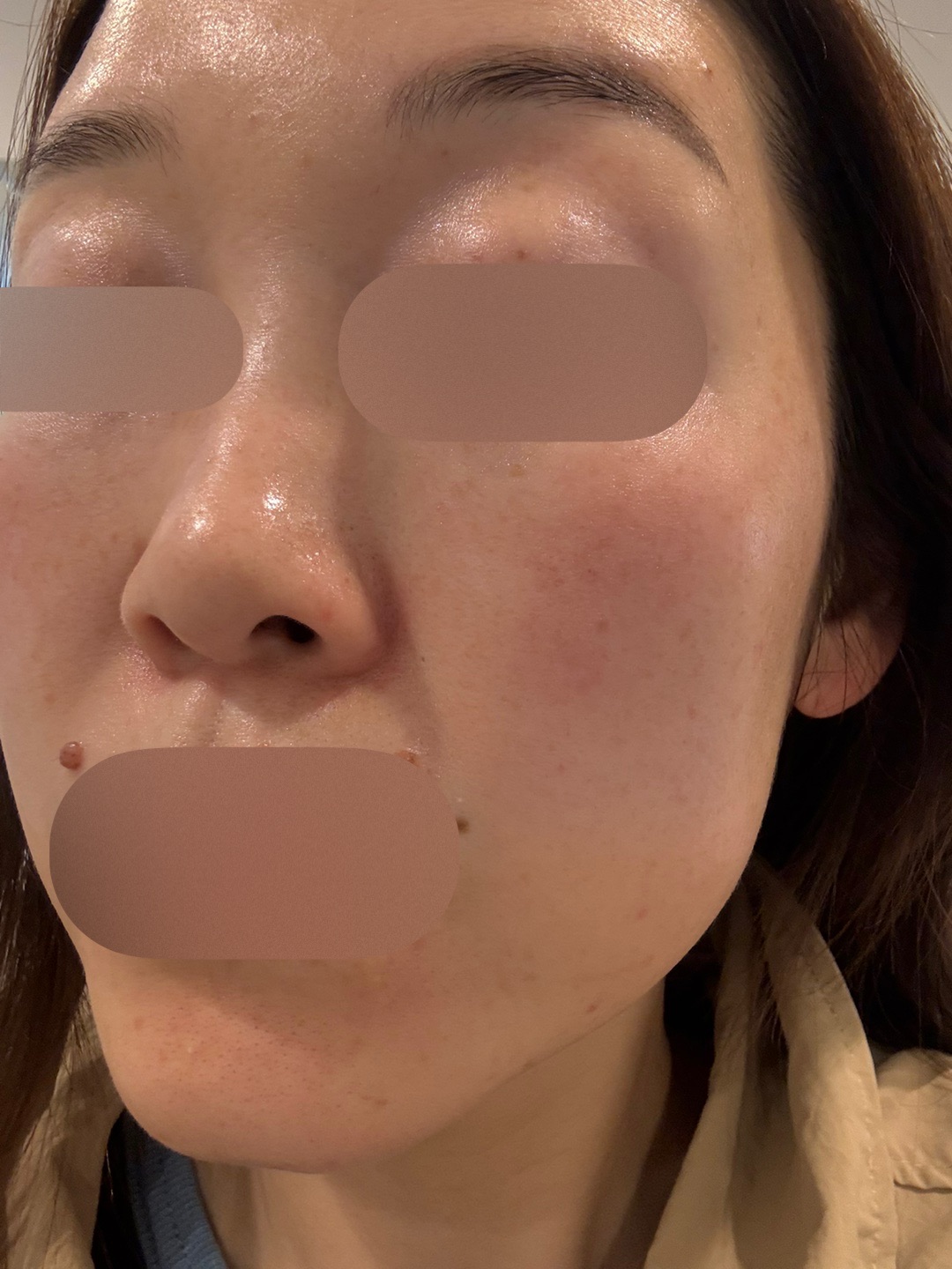 ピコトーニング＋マッサージピール【1月15日迄にご予約頂いた方】 | ZX