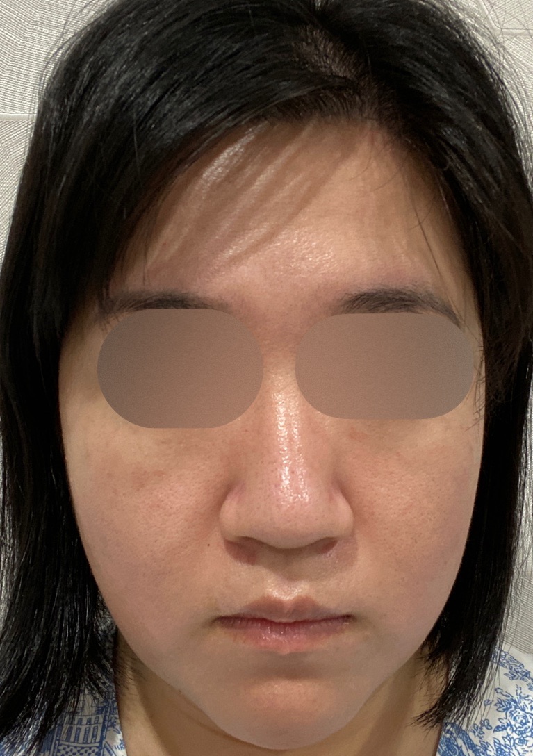 一代エレクトロポレーション　ハイドラフェイシャル 一代エレクトロポレーション ハイドラフェイシャル