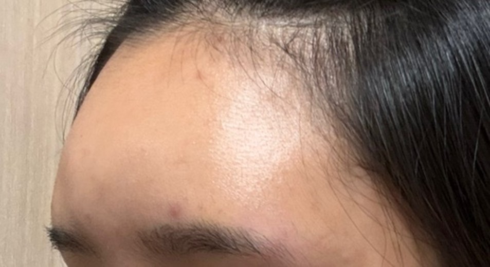 after photo: 이마필러, 관자놀이필러