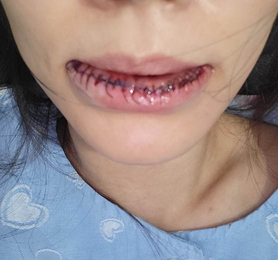 after photo: 입술축소술