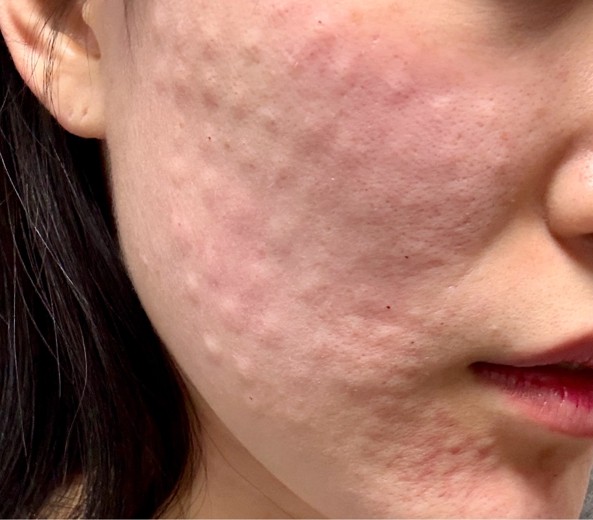 after photo: 리쥬란힐러