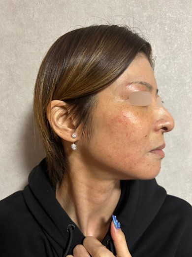 before photo: IPL(光/フォト治療), エレクトロポレーション