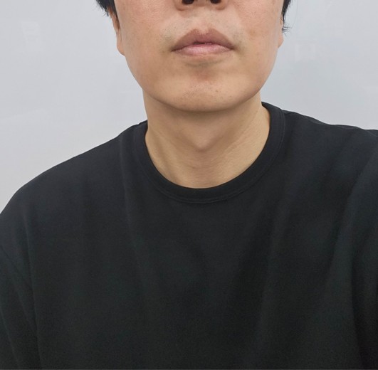 before photo: 아쿠아필링, 수염제모