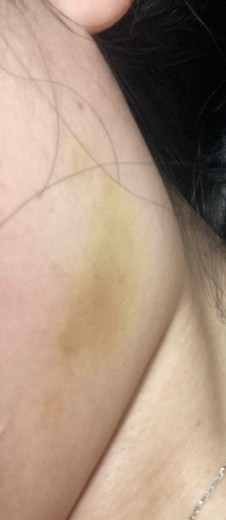 before photo: 윤곽주사, 사각턱보톡스