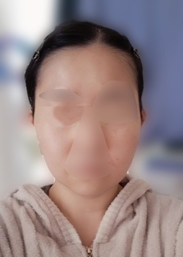 after photo: ウルトラセルQ+(ハイフ)