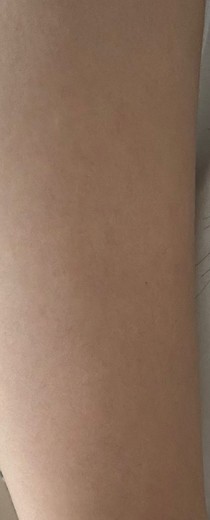 after photo: 팔지방분해주사