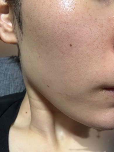 before photo: イオン導入