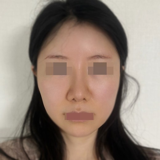 after photo: 코재수술, 콧대(보형물), 복코교정(수술)