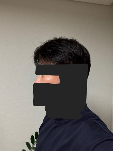 after photo: 눈밑지방재배치