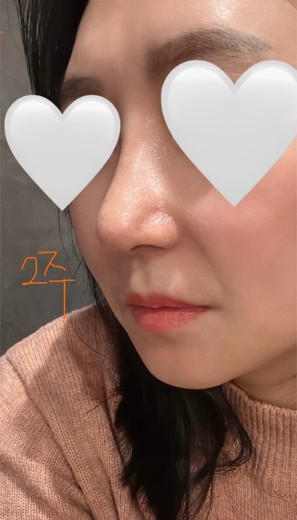 after photo: 콧대(보형물), 코끝(자가연골)