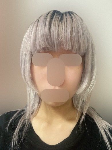 after photo: 首・広頚筋ボトックス