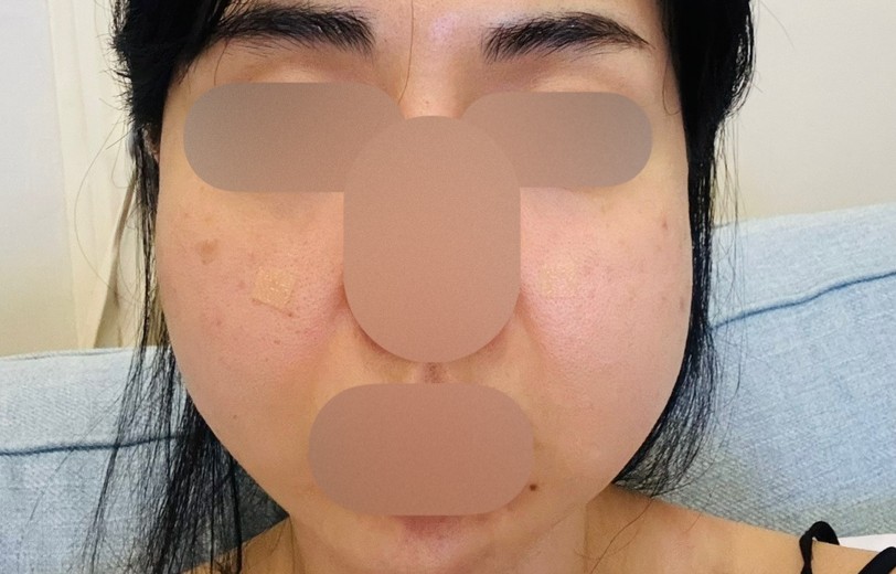 after photo: PRP피부재생술