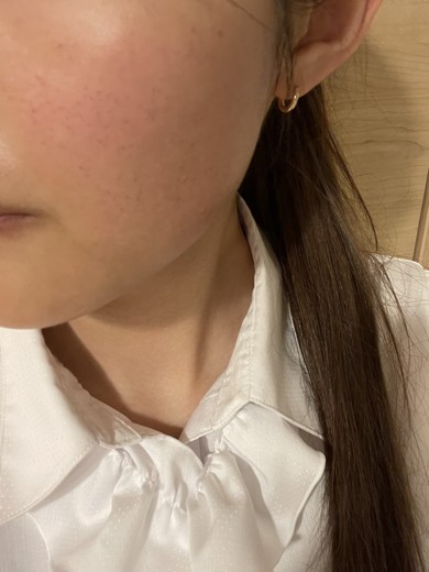 after photo: ピーリング, ルメッカ