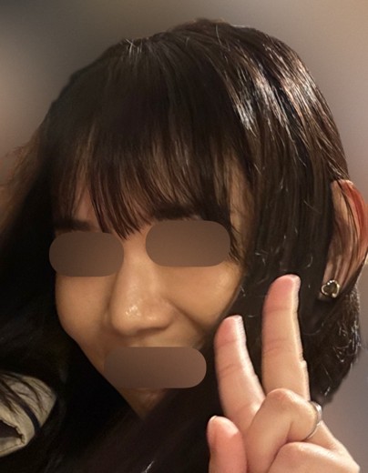 after photo: サーモン注射