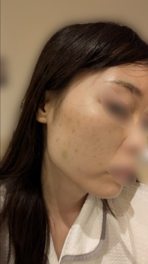 after photo: 脂肪溶解注射(腕), 脂肪溶解注射(太もも)