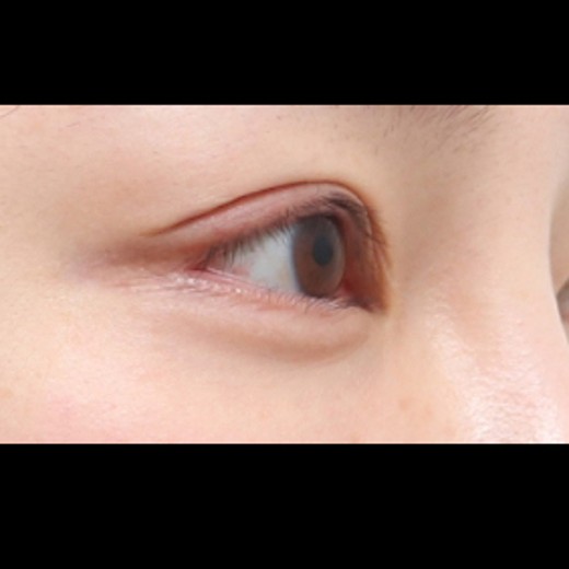 before photo: 밑트임, 뒤트임