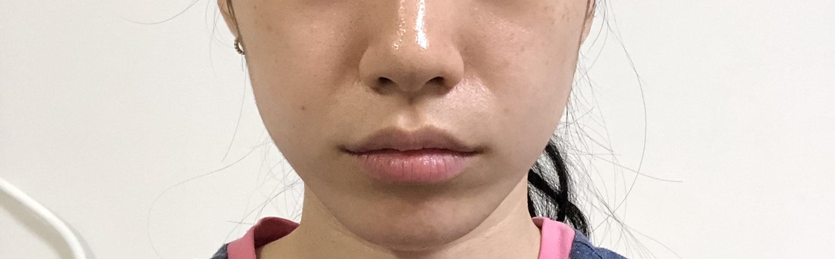 after photo: 입꼬리필러, 입술필러