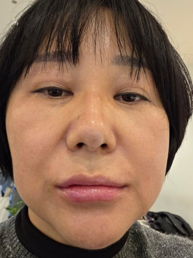 after photo: 입술필러