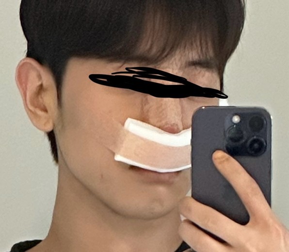 after photo: 콧대(자가조직), 콧볼축소