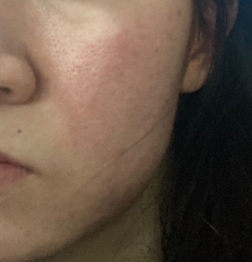 after photo: 스킨스케일링, 네오빔