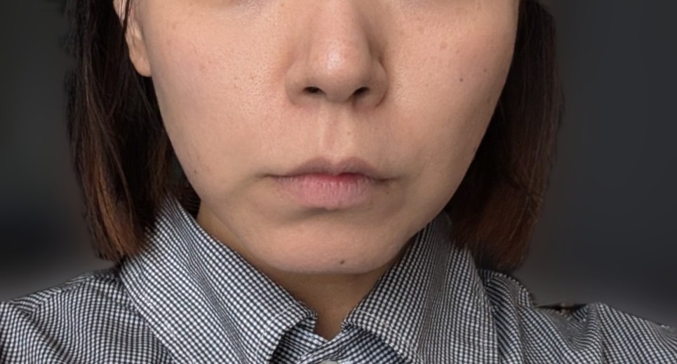 after photo: ハイフ(HIFU)