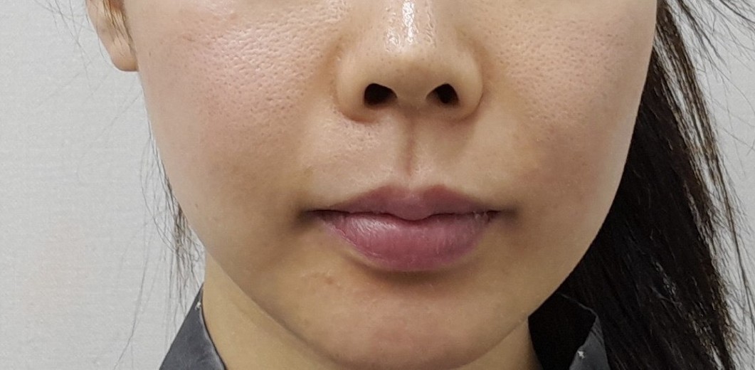before photo: リジュランヒーラー, スキンボトックス