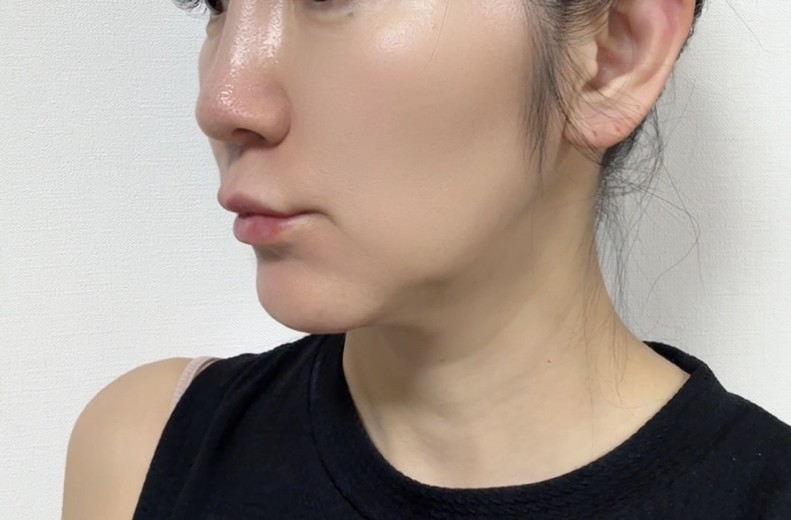 after photo: チタニウムリフト