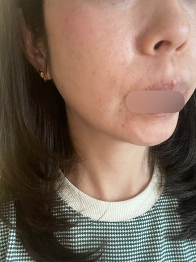 after photo: フラクショナルレーザー, エレクトロポレーション