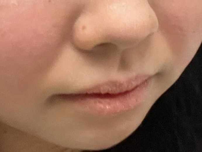 after photo: 脂肪溶解注射(顔)