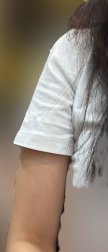 after photo: 팔지방분해주사