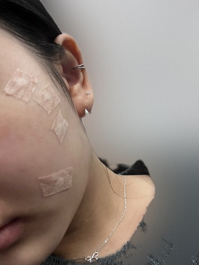 before photo: 점제거시술, 사마귀제거