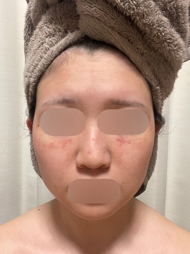 after photo: ダーマペン, エクソソーム
