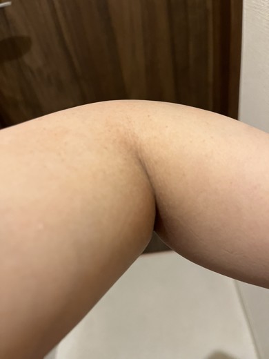 after photo: 脂肪溶解注射(腕)