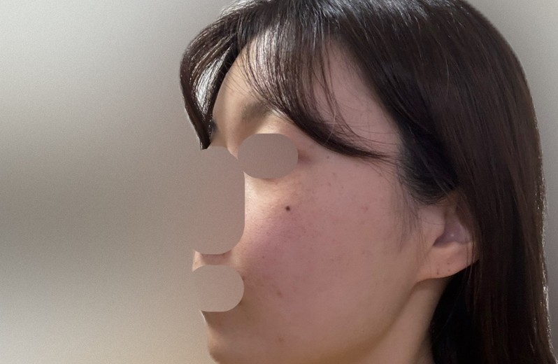 before photo: エレクトロポレーション