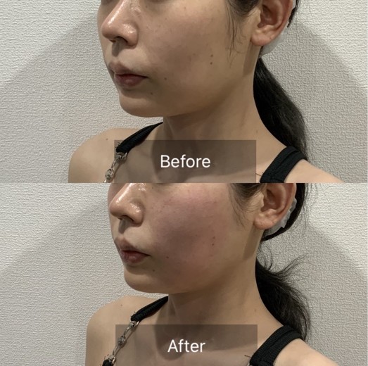 after photo: チタニウムリフト, ミラノリピール
