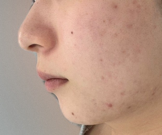 before photo: IPL(光/フォト治療)