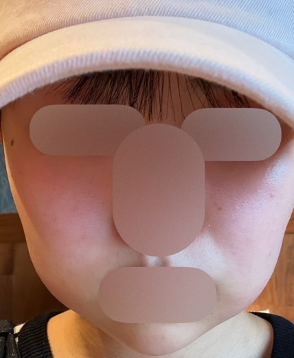 after photo: 脂肪溶解注射(顔)