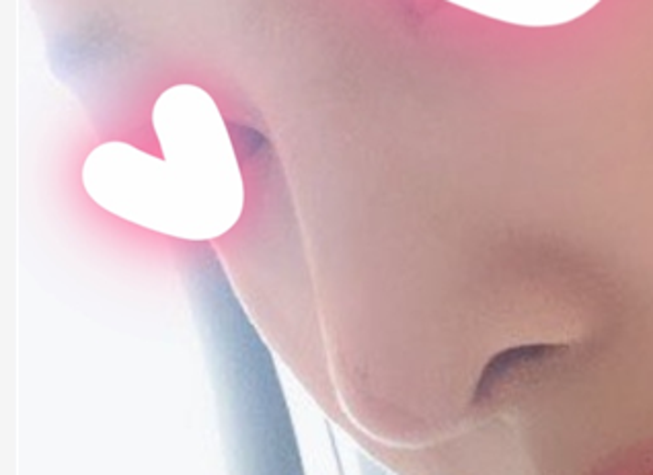 after photo: 코재수술