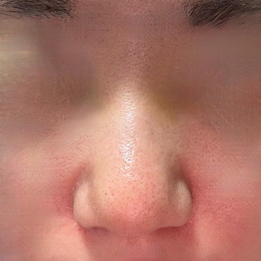 after photo: 콧볼축소, 복코교정(수술)