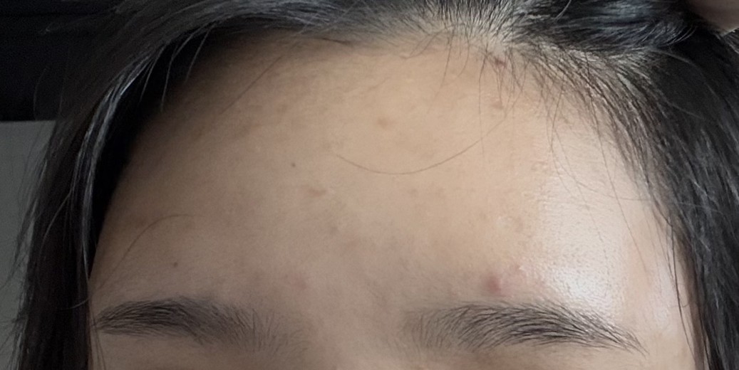 after photo: 이마필러, 관자놀이필러