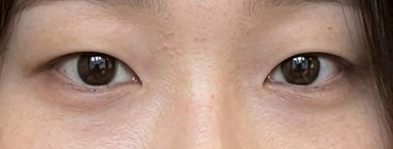 시술 전